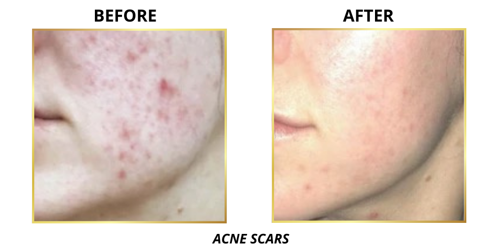 before and after acne scar reduction