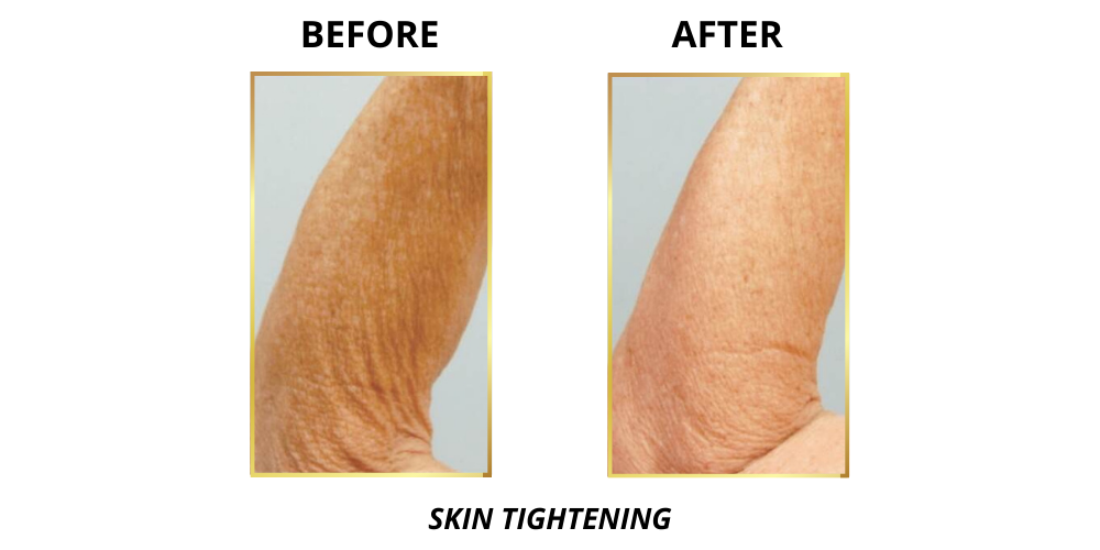 before and after arm skin tightening