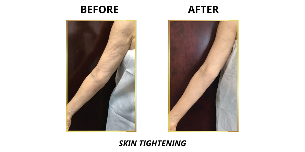 arm skin tightening treatment